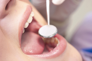 予防歯科はなぜ必要なのか？