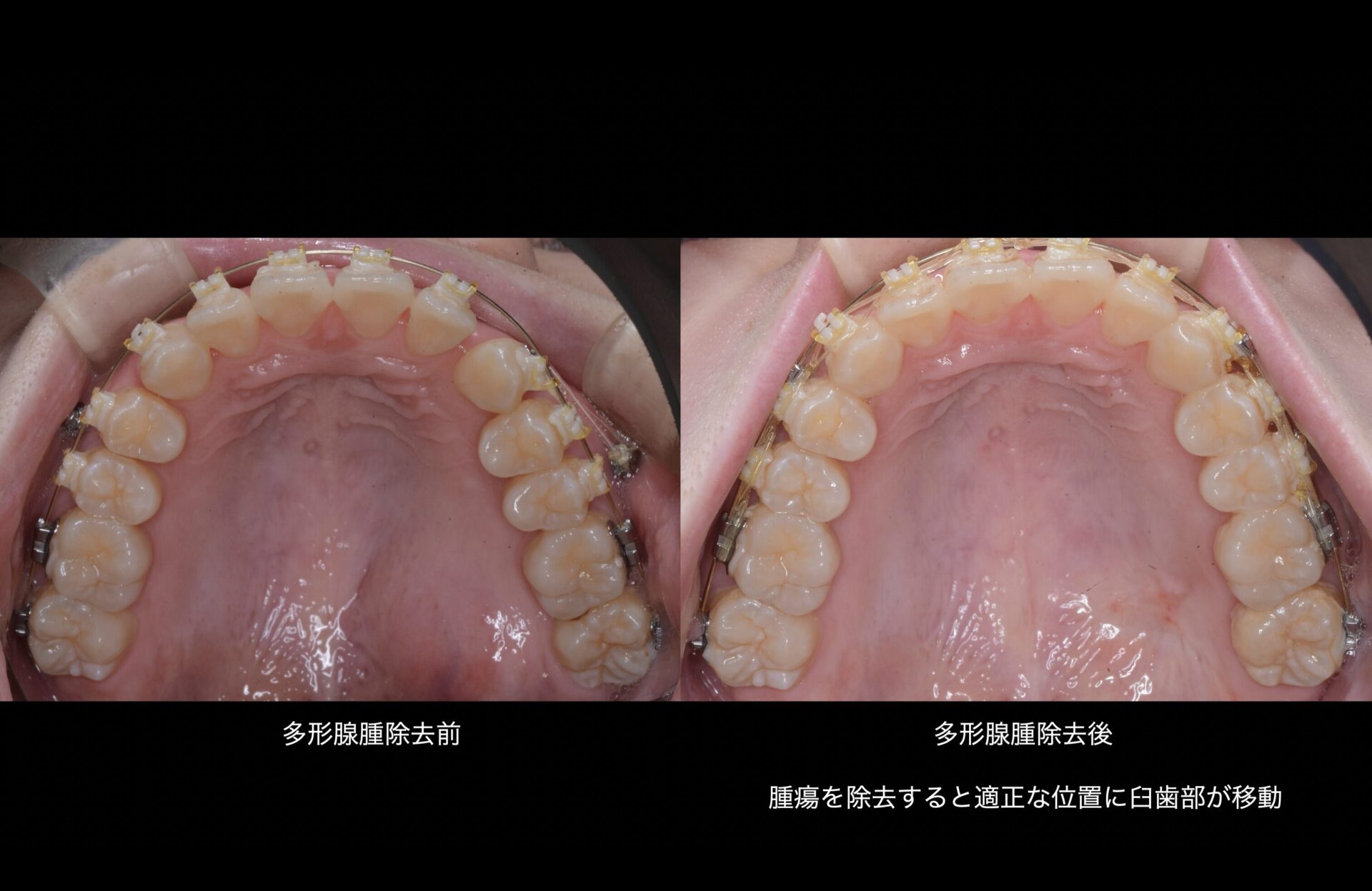 MFTの臨床 咬合の小進化と歯科疾患 MFTの臨床 咬合の小進化と歯科疾患 よくわかる咬合採得: 部分治療から