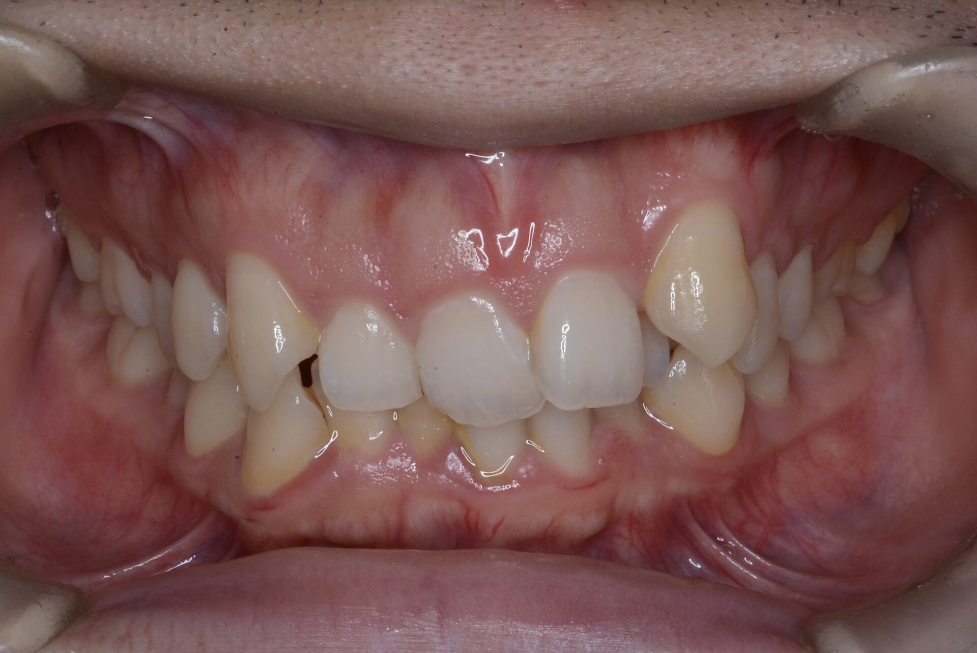 before